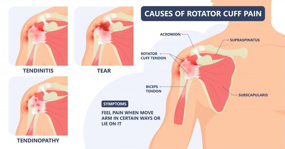 Shoulder Impingement