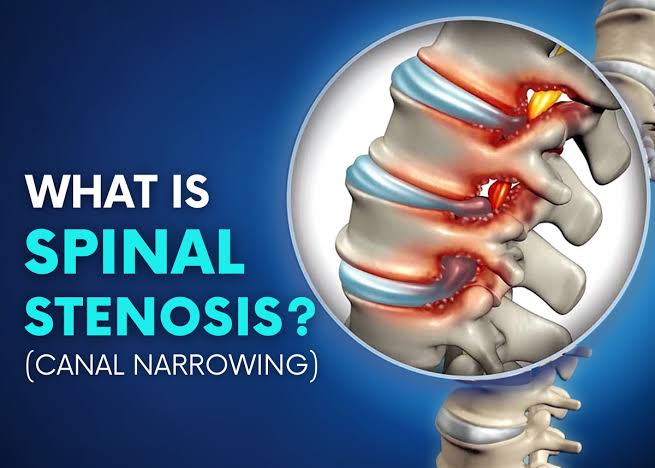 spinal stenosis