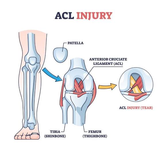 Anterior Cruciate Ligament (ACL) Injury