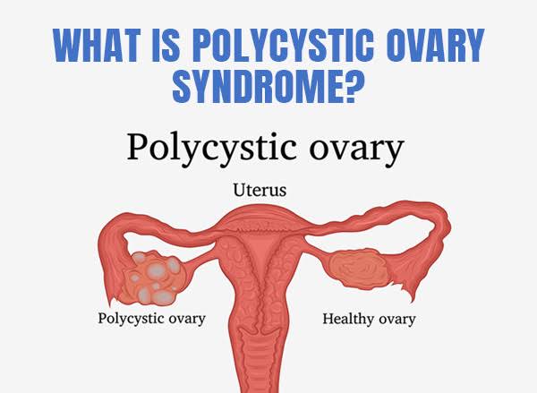Polycystic Ovary Syndrome