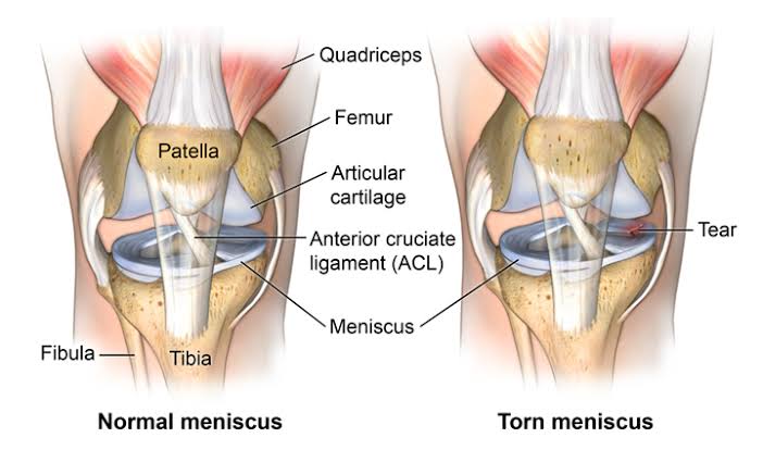 Meniscus Tear Knee Injury