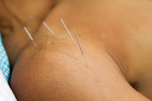 acupuncture is very good at treating shoulder pain . acupuncture is very good at treating shoulder pain .