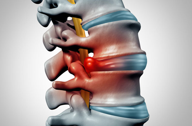 Herniated Disk
