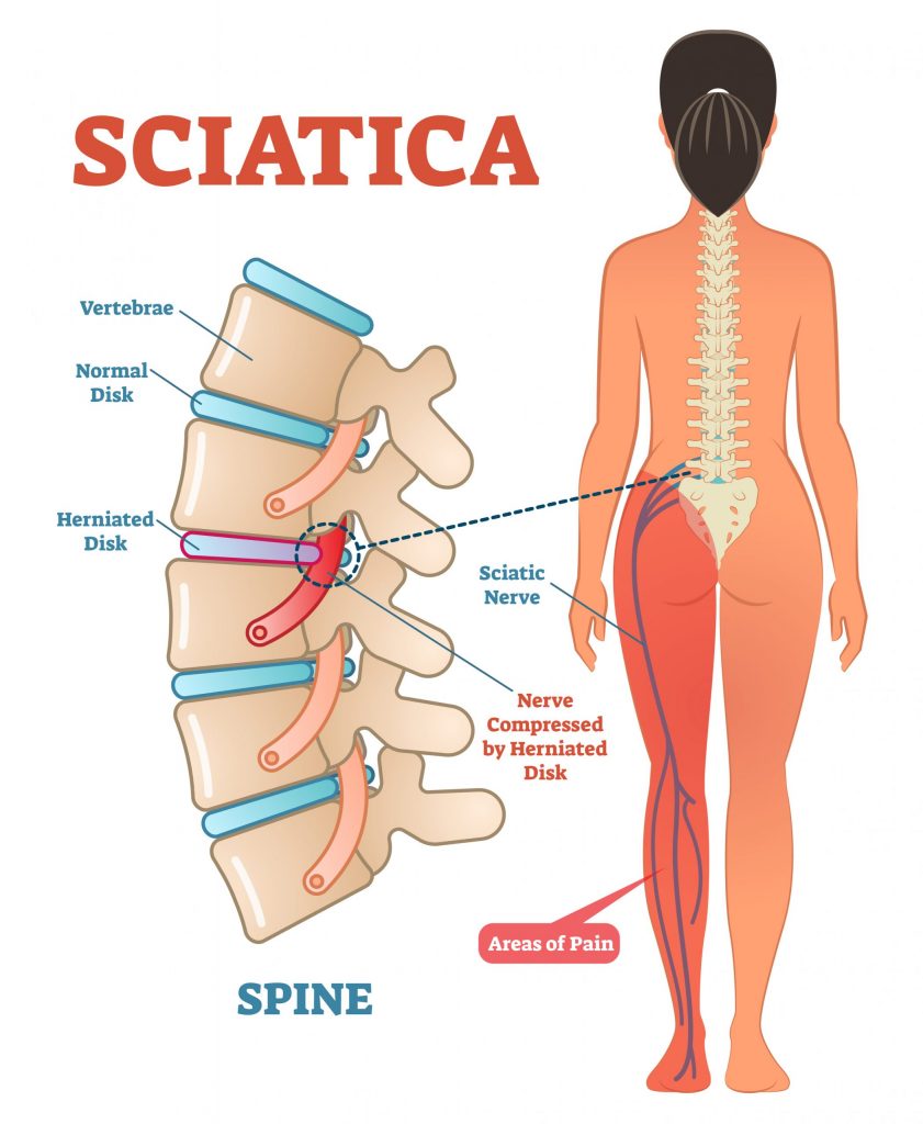 The Sciatica Pain