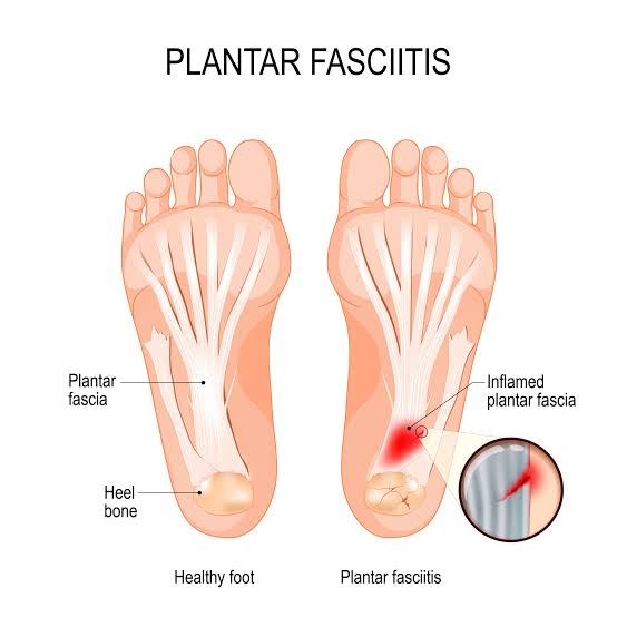 plantar fasciitis