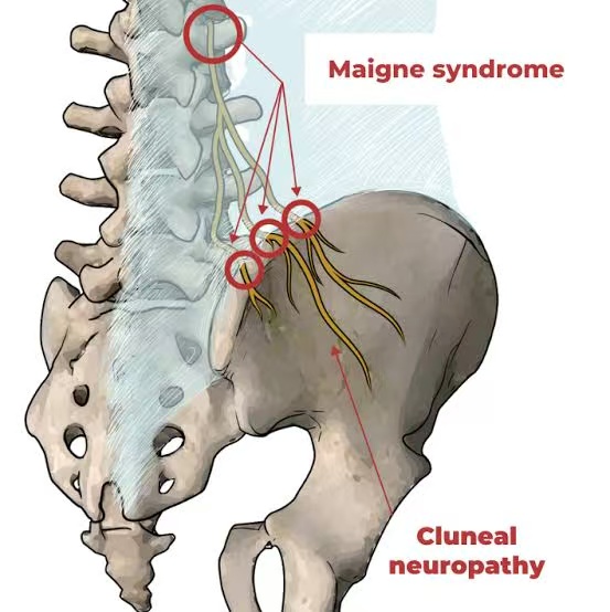 Superior Cluneal Nerve Entrapment