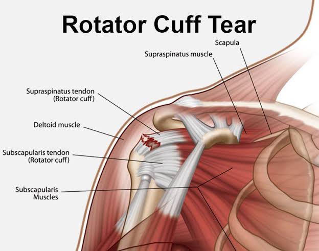 Rotator Cuff Tear
