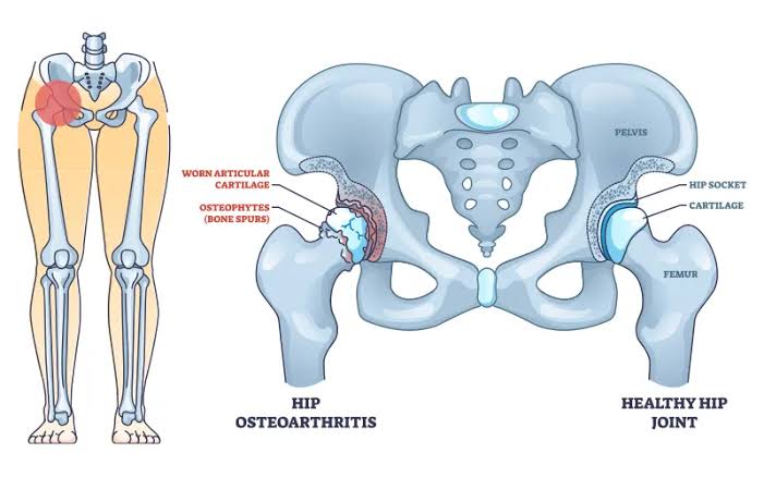 Hip Osteoarthritis