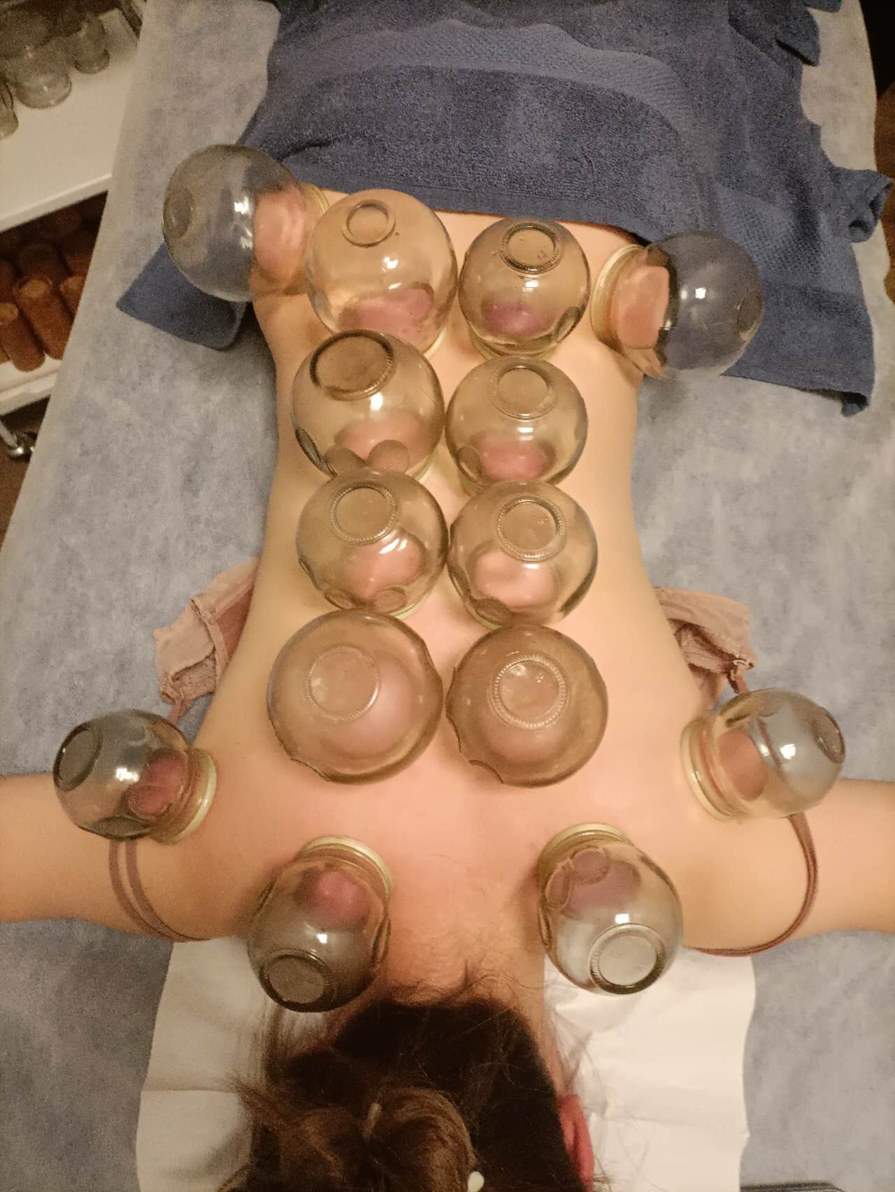 Cupping Therapy