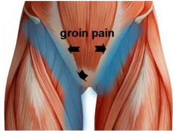 Iliopsoas Related Groin Pain