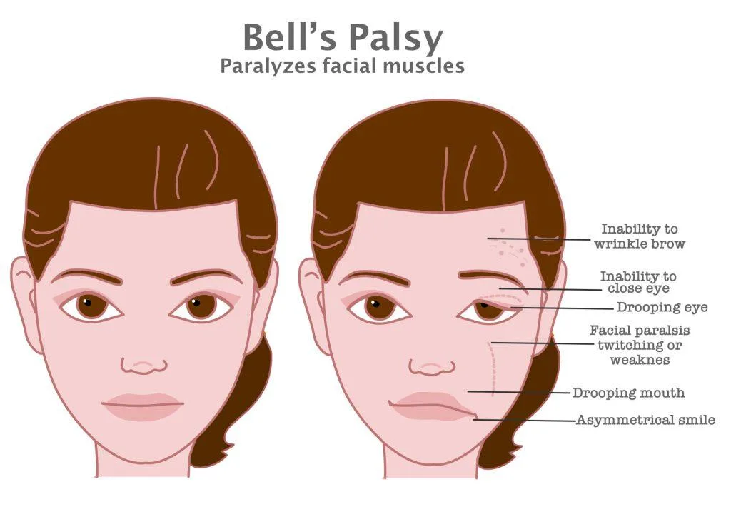 Illustration comparing a typical face with signs of Bell’s palsy, including difficulty wrinkling the brow or closing the eye, a drooping eye and mouth, and an asymmetrical smile