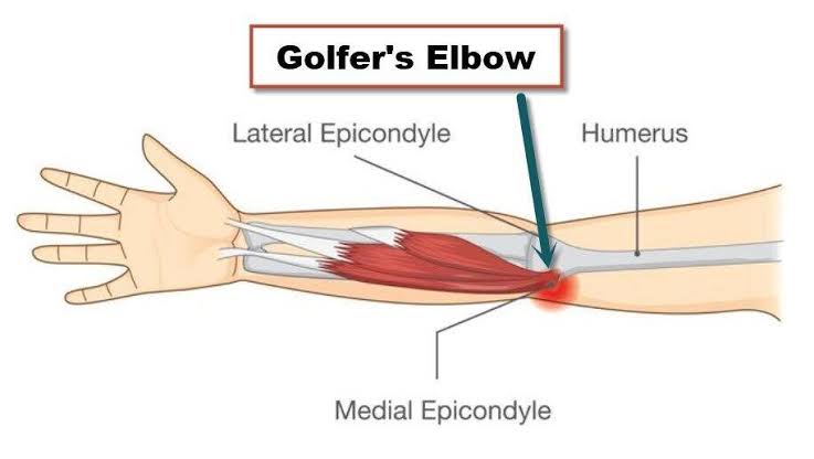 Golf Elbow