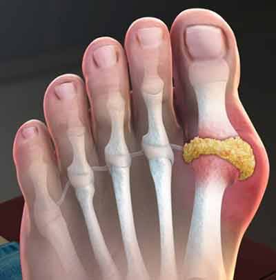 Gout