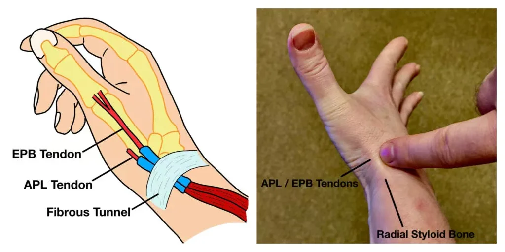 De Quervain’s Tenosynovitis: Understanding “Mother’s Thumb”