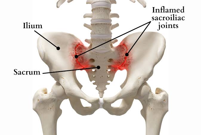 Sacroiliitis