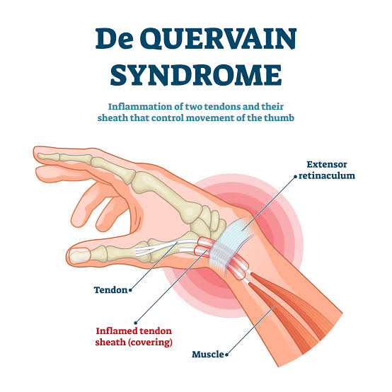De Quervain tenosynovitis