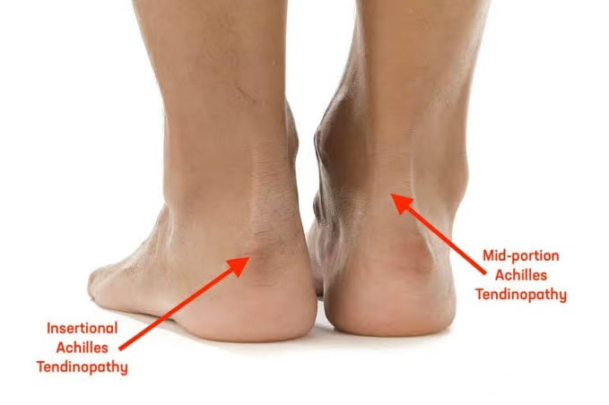 What is Achilles tendinitis?