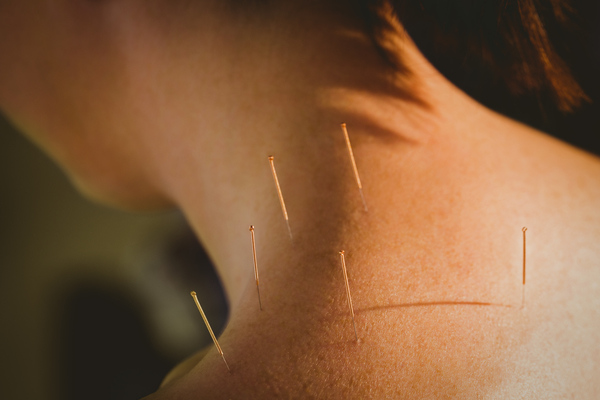 Young woman getting acupuncture treatment in therapy room Young woman getting acupuncture treatment in therapy room
