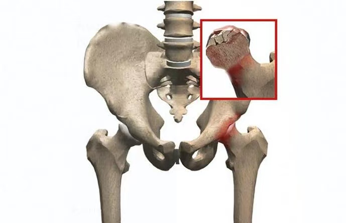 Avascular Necrosis of the Femoral Head