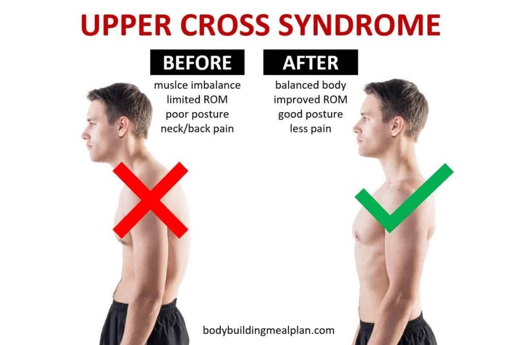 The Upper-crossed Syndrome