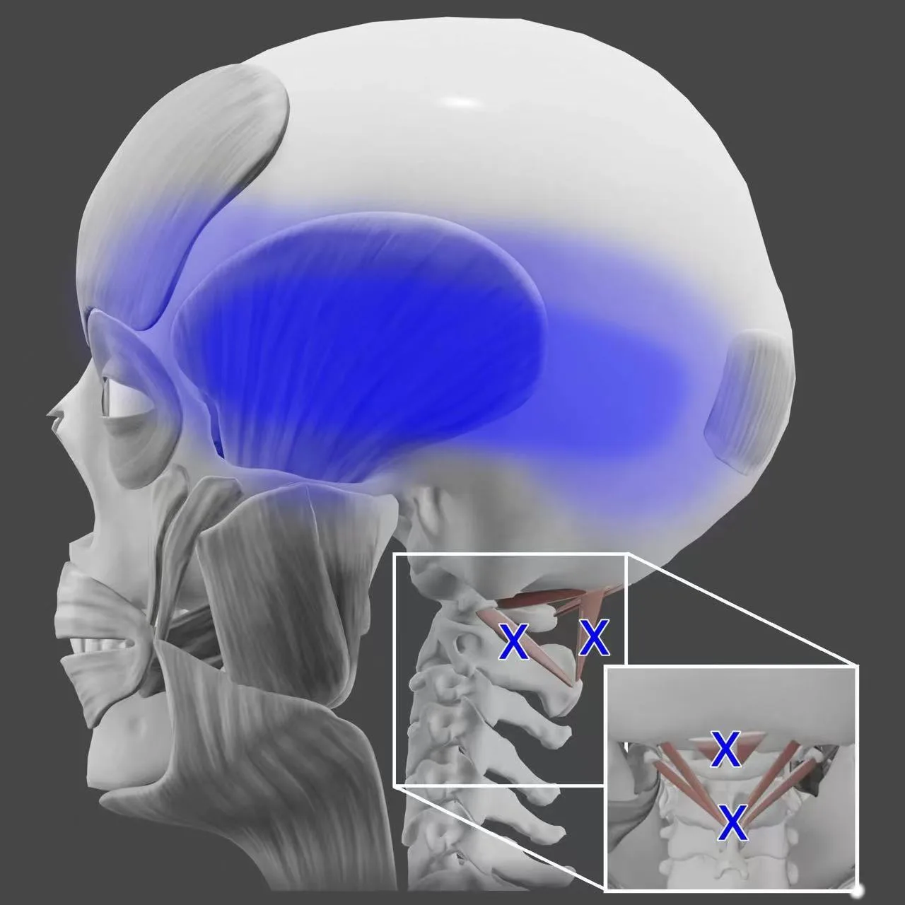 Migraine and Neck Pain: How the Muscles at the Base of Your Skull Fit In