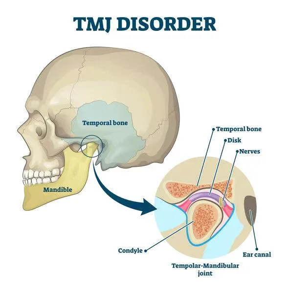 Anatomical illustration of the temporomandibular joint showing the temporal bone, articular disc, nerves, mandibular condyle and ear canal