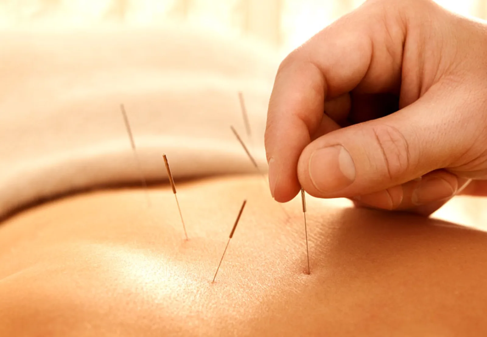 Acupuncture treatment at Midtown Wellness