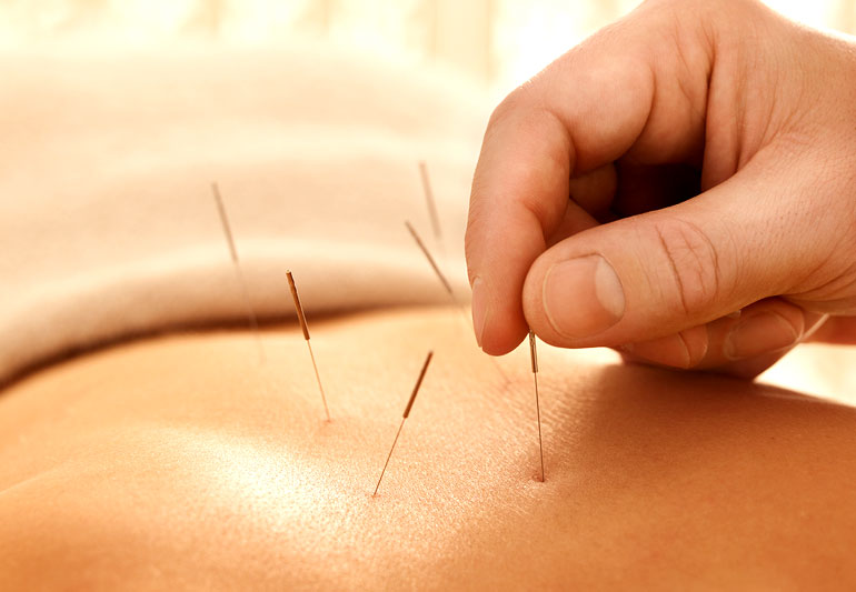 accupunctureMyths-97538838-770x5