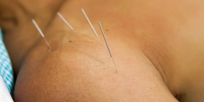 acupuncture is very good at treating shoulder pain . acupuncture is very good at treating shoulder pain .